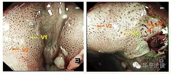 6个精彩病例带你领略早期食管癌的内镜下诊治