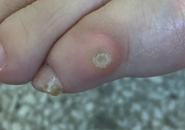 水瘊子去掉母瘊子还会长吗,肉瘊子用手抠了会怎样