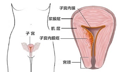 得了癌症还可以结婚生子么,妇科癌症会不会遗传