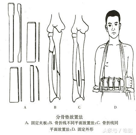 小孩尺桡骨骨折后期自我塑形,儿童尺骨桡骨远端骨折第九周