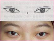 下眼睑下垂术后眼睛会恢复吗,眼睑下至手术前后对比图