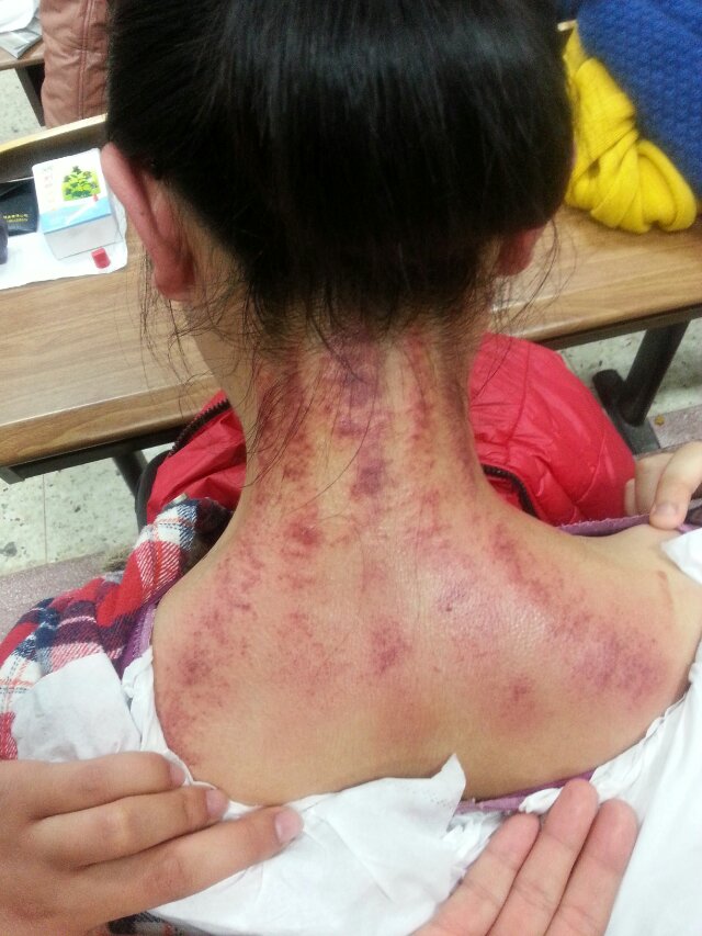 养生的刮痧穴位配图说明,中医养生10种刮痧方法刮走疾病