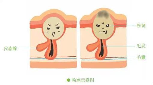 清除鼻头粉刺的正确有效方法,鼻头粉刺正确处理方法
