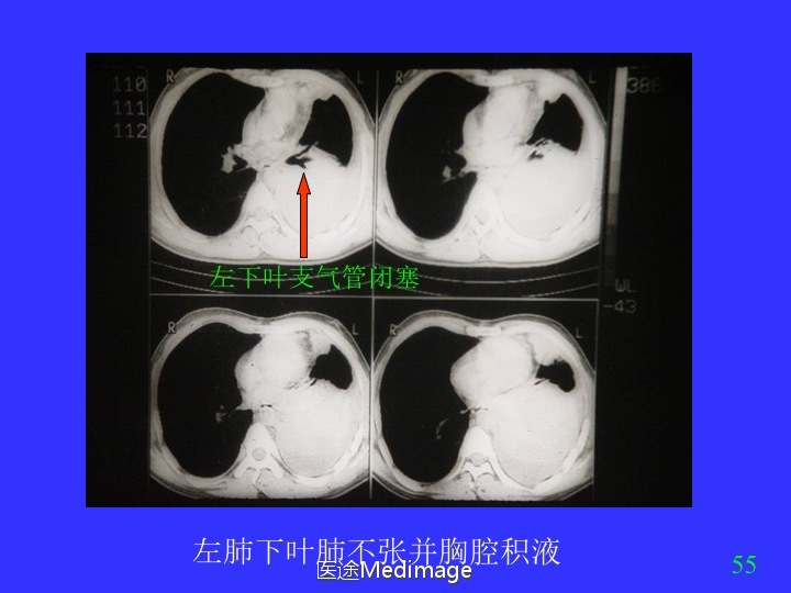 胸部ct扫描双肺未见明显异常,胸部ct报告心脏不大正常吗