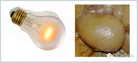 有趣痔疮的知识讲解,怪异的痔疮