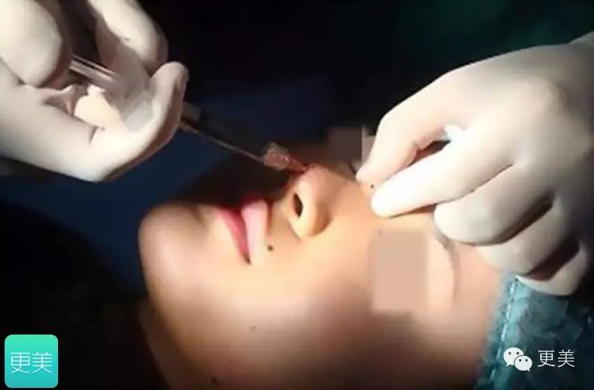 水光针和隆鼻用的玻尿酸有区别吗？