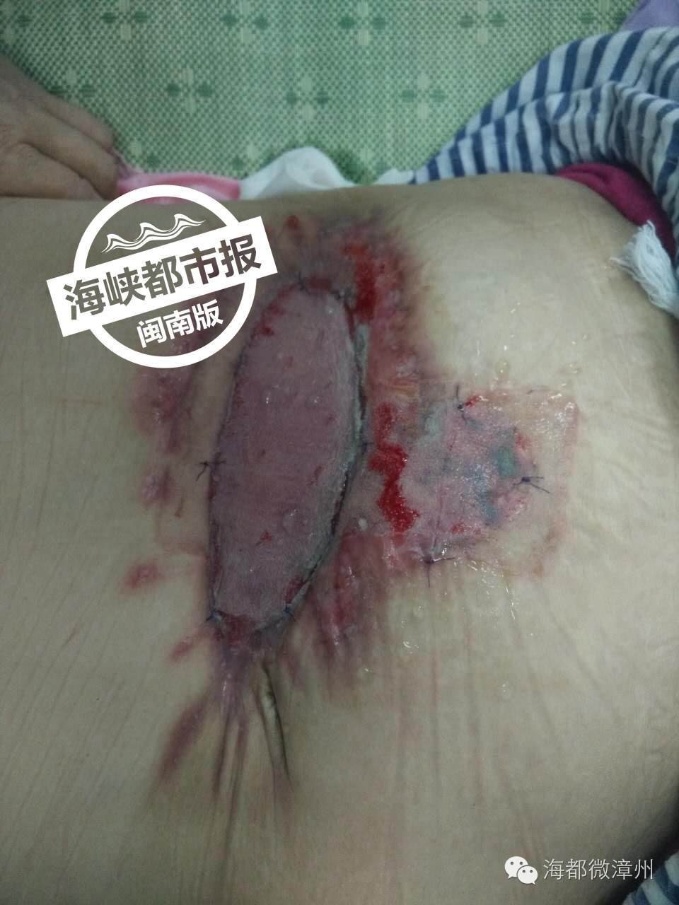 大妈被虫子咬,福建被虫咬案例