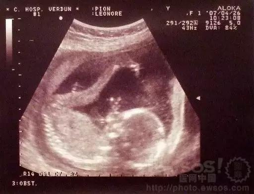 孕期b超对胎儿辐射有影响吗,b超有辐射吗多长时间可以做一次