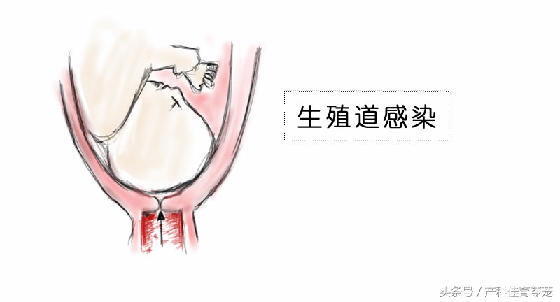 破水了，害怕吗？产科医生教您这样应对