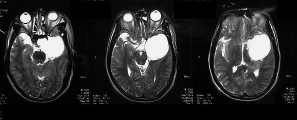 海绵窦海绵状血管瘤,海绵窦区海绵状血管瘤发病年龄
