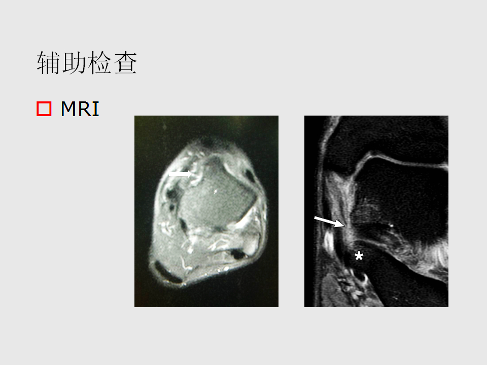 脚崴了怎么办判断是否骨折,脚崴了怎么办视频