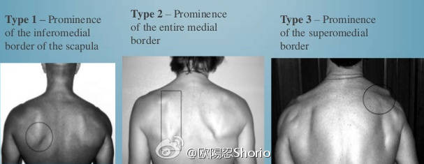 肩胛骨外翻含胸驼背正确矫正方法,好体态矫正法