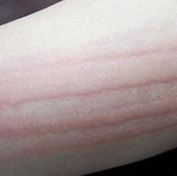 儿童当心哪些皮肤病,所有的皮肤病都有这些表现