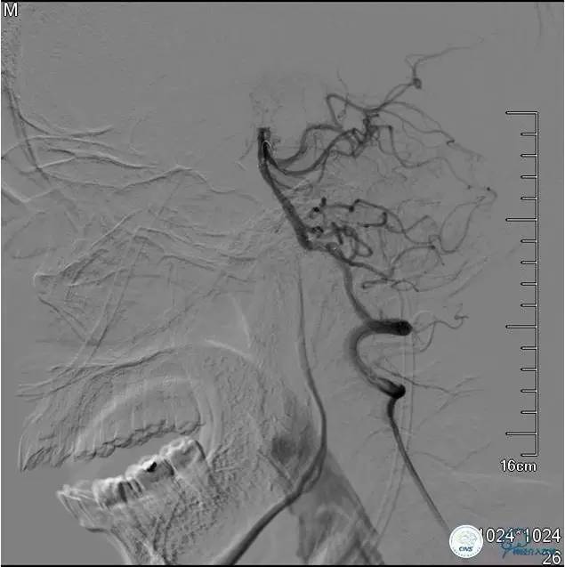 中医治疗基底动脉闭塞,基底动脉尖综合征病例分享