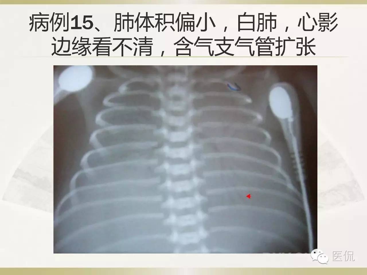 「资料丨医看分享」南边老师肺部群：新生儿透明膜病（HMD）医学影像