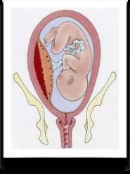 中央型前置胎盘大出血发生概率,怀孕六个月胎盘前置突然大出血