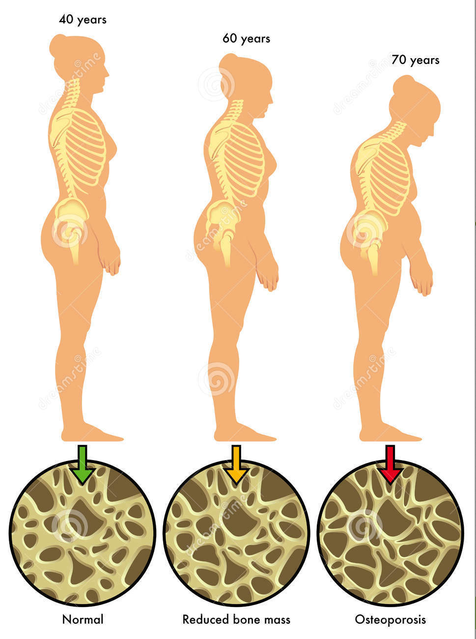 人到中年后骨质疏松要怎么治,中老年人骨质疏松该怎么办