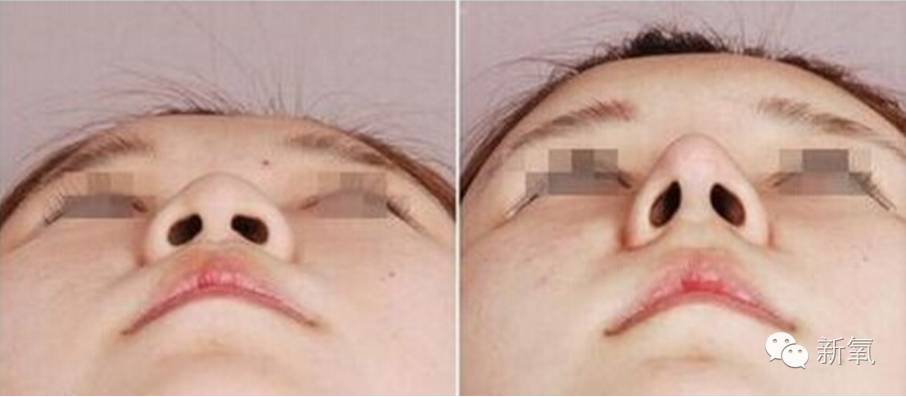 林允是不是整鼻子了,林允隆鼻过吗