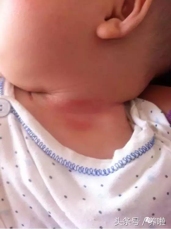宝宝脖子淹了破皮红了怎么办,新生儿脖子淹了破皮用氧化锌软膏