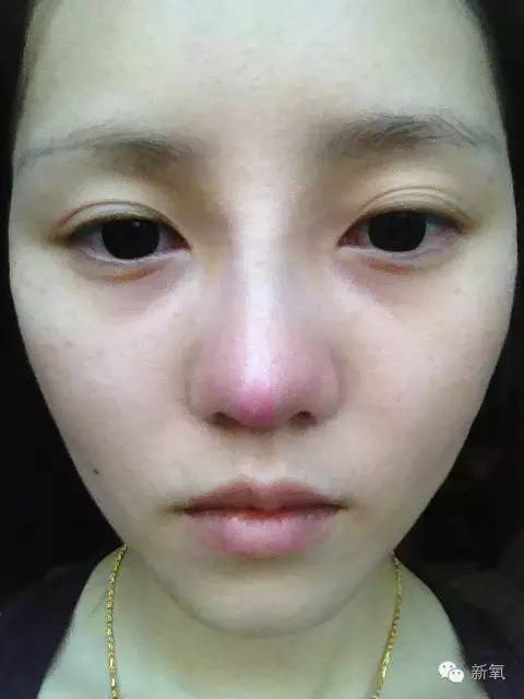 林允是不是整鼻子了,林允隆鼻过吗