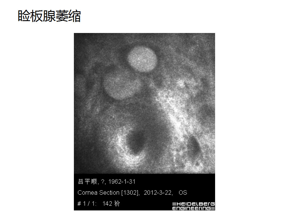 眼睑缘炎的发病原因,眼睑炎的症状和治疗方法