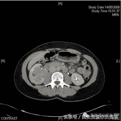 女性肉眼血尿无痛是怎么回事,老年女性无痛性血尿的原因