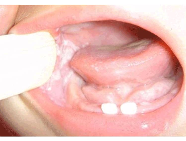 新生儿鹅口疮是什么引发的,新生儿鹅口疮原因