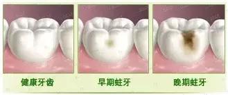 牙齿发酸流口水怎么回事,牙齿吃东西发酸发软怎么治