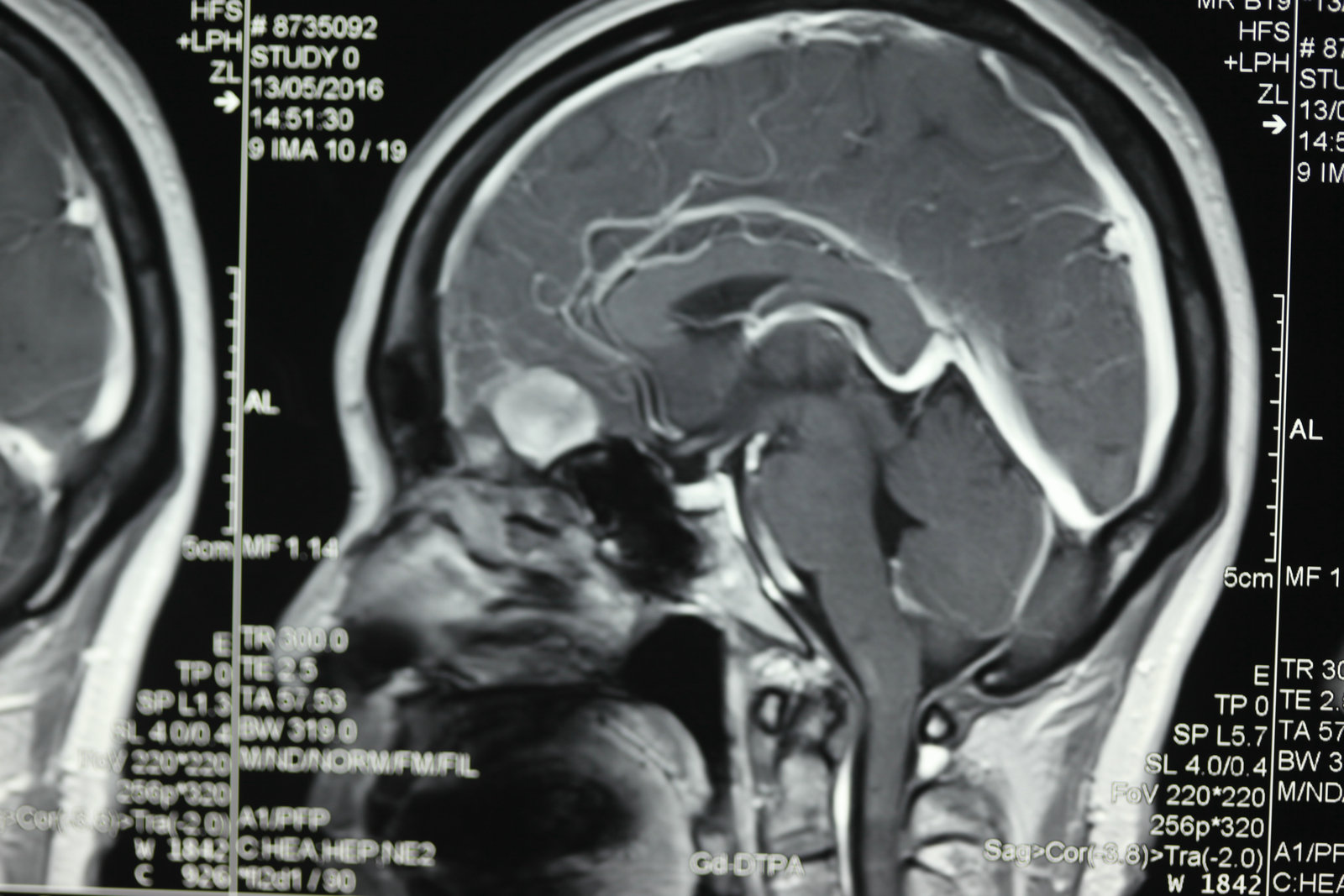 神经外科纪实视频,显微神经外科手术费用