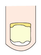 指甲出现白点、纵纹是怎么回事?