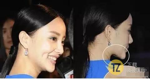 杨幂下颌角手术对比,杨幂下颌角手术对比图文
