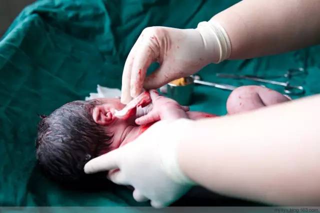 剖腹产恢复很好的照片,剖腹产完全恢复照片