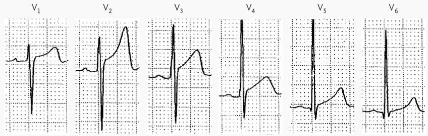 心电图st段呈j点型抬高是什么意思,心电图st段抬高一定是心梗吗