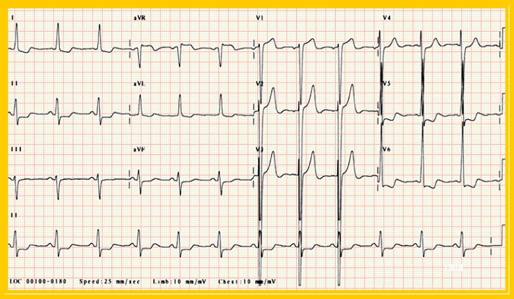 心电图st段抬高0.05mv是什么意思,心电图st段抬高但心脏彩超都正常