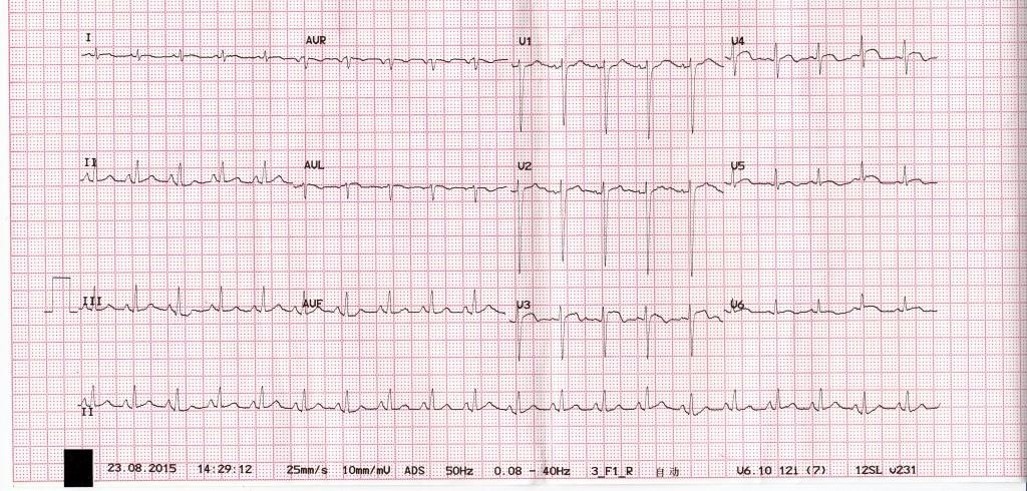 心电图st段抬高0.05mv是什么意思,心电图st段抬高但心脏彩超都正常