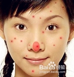 怎样消除青春痘和粉刺最快的方式,如何有效祛除青春痘