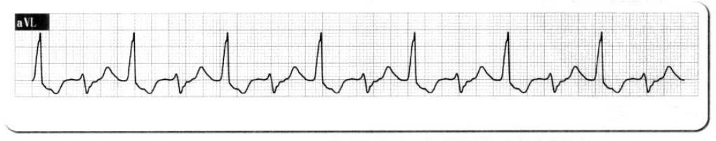 服用什么药物心电图就会正常,服药后做心电图