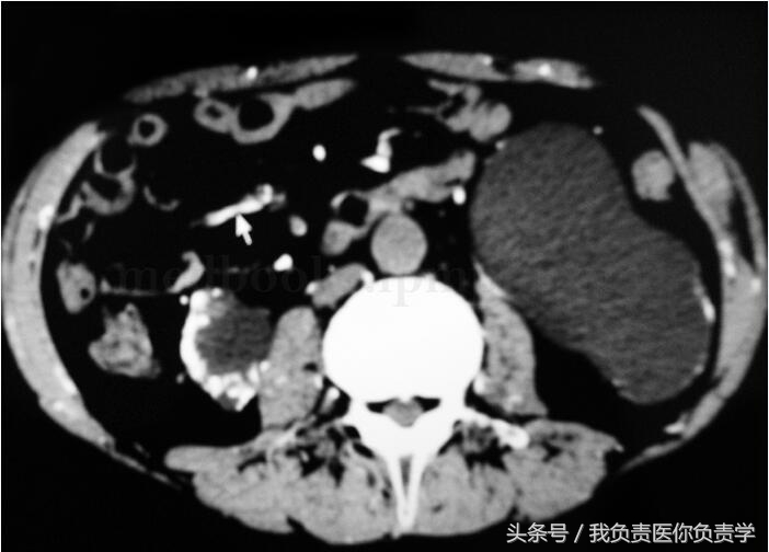 肾移植后坏死能活多久,肾移植后常见的感染部位有哪些