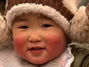冬天脸红发热是什么原因造成的,宝宝冬天脸红擦什么面霜比较好