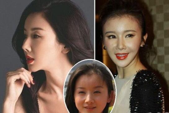 整容保质期大概多久,明星整容一般多久恢复