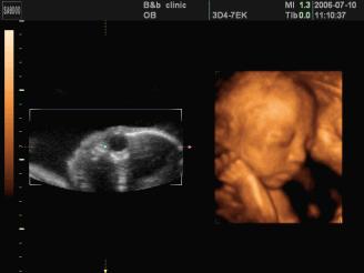 镇原协和医院四维彩超怎么样,镇原做四维多少钱