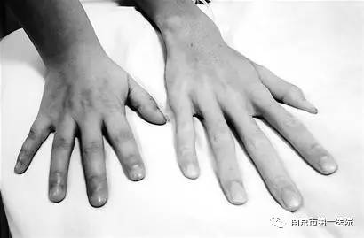 17岁少年心脏病手术,小女孩做了4次心脏手术