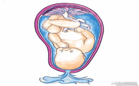 少量破水没有宫缩多久需要去医院,破水不宫缩不见红肚子不痛怎么办