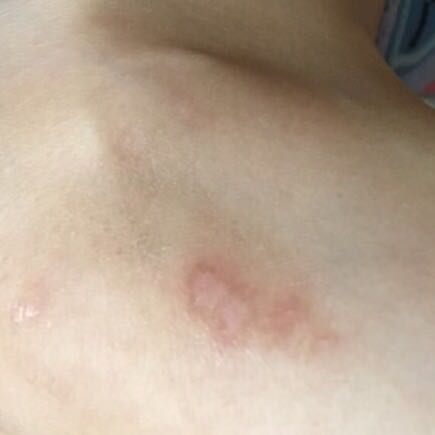 推荐一款好用祛疤膏,新增祛疤膏推荐