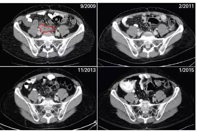 基因检测卵巢癌晚期有必要吗,基因检测卵巢癌风险高怎么办