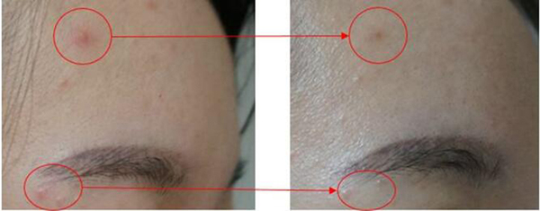 右脸长痘痘怎么治,右边脸上长痘痘怎么快速消除