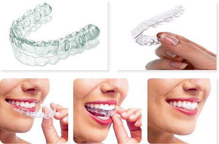 牙齿矫正隐形哪个品牌最好,牙齿矫正隐形牙套什么价格