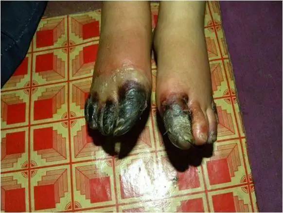 冬天生冻疮怎么办简单方法,冬天长冻疮是因为太冷了吗