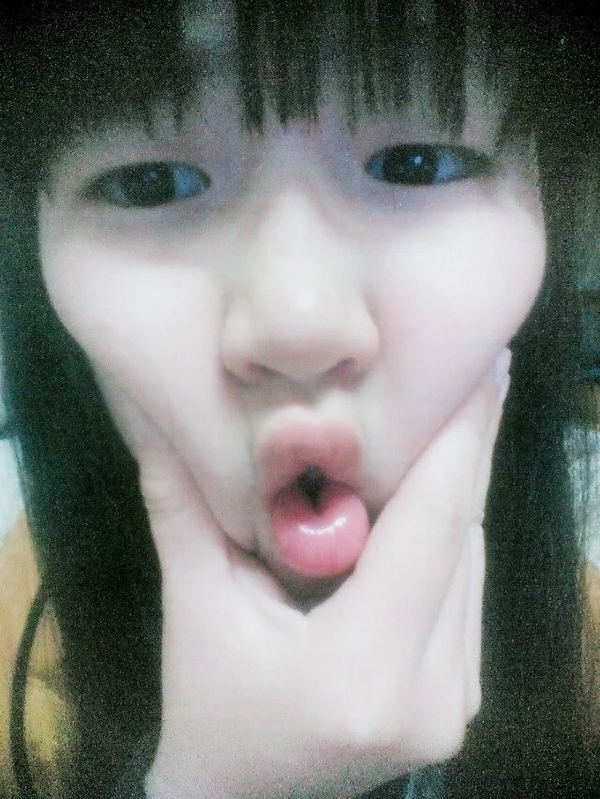 割完双眼皮后眼部吸脂,抽脂双眼皮做完眼睛有褶