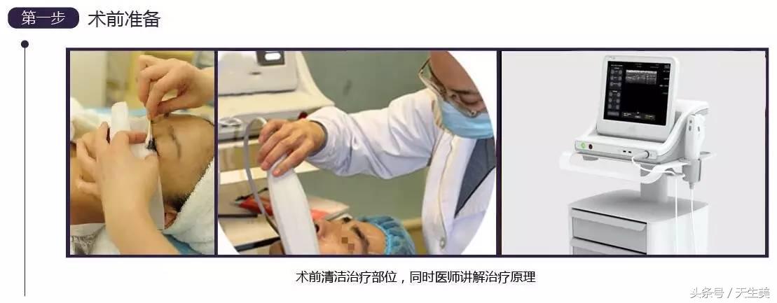 超声刀值得做吗 (超声刀怎么样啊)